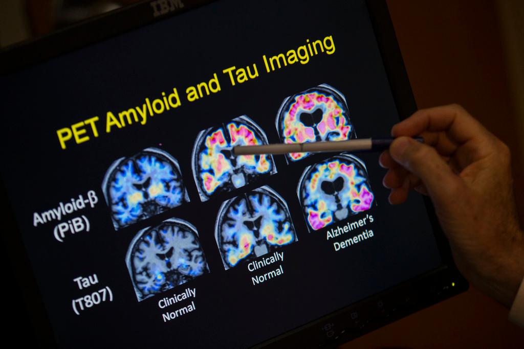 R. Scott Turner, Professor of Neurology and Director of the Memory Disorder Center at Georgetown University Hospital, points to PET scan results that are part of a study on Alzheimer's disease at Georgetown University Hospital