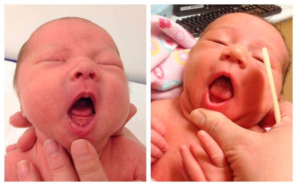 A baby with ankyloglossia where the tongue does not extend beyond the gums, left, and a baby with an indentation at the tip of a the tongue which may be a sign of ankyloglossia