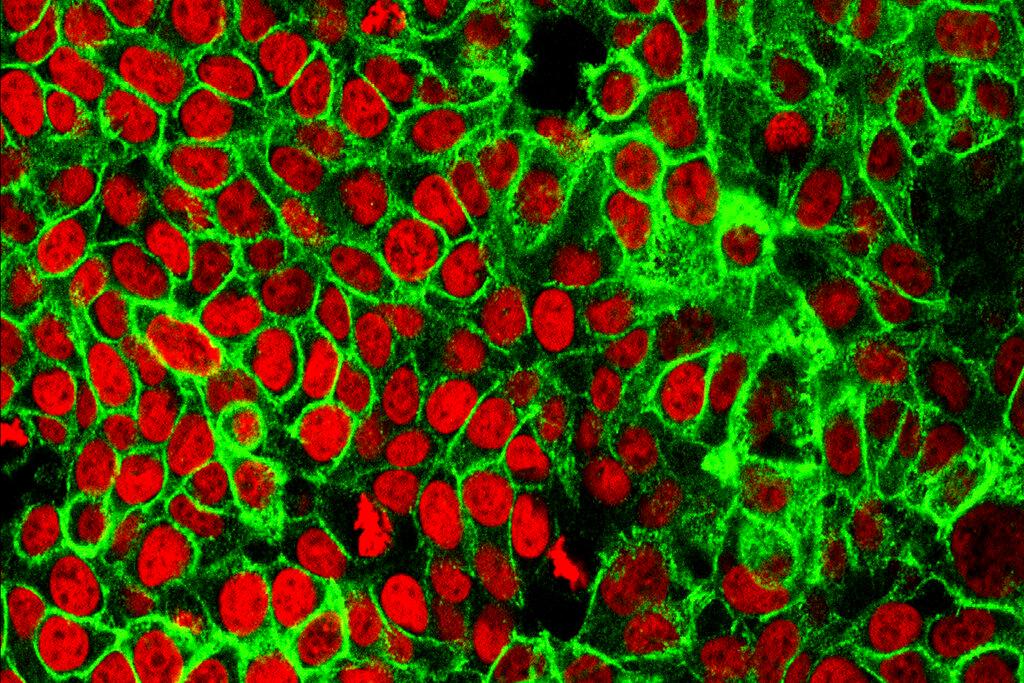 microscope image shows human colon cancer cells with the nuclei stained red