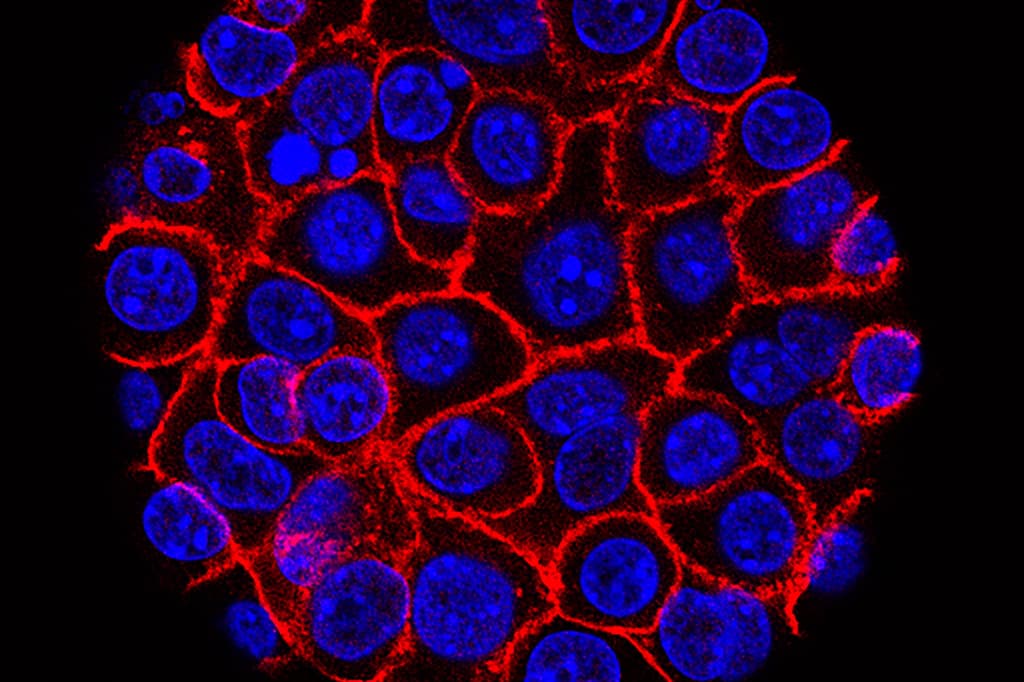 "I Actually Started Crying" - New Hope For Deadly Pancreatic Cancer