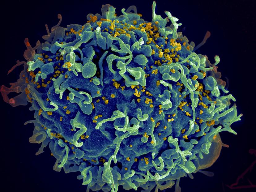 Human T cell, in blue, under attack by HIV, in yellow