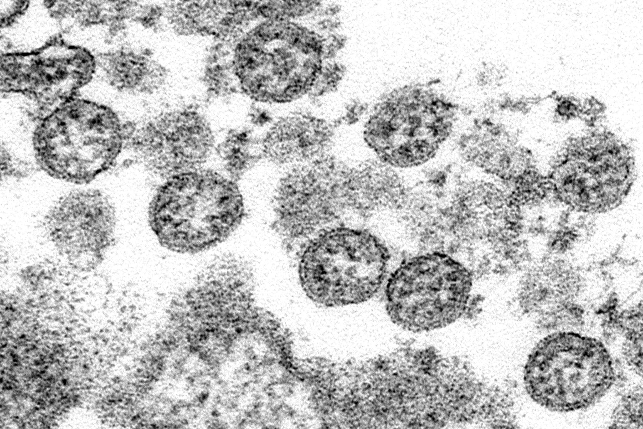 Image of spherical coronavirus particles from the first U.S. case of COVID-19