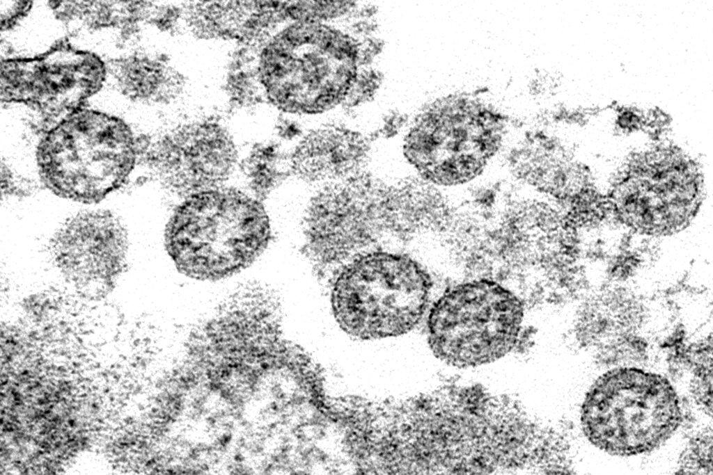 Spherical coronavirus particles from what was believed to be the first U.S. case of COVID-19